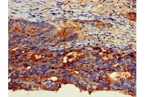Immunohistochemistry of paraffin-embedded human colon cancer using ABIN7146803 at dilution of 1:100 (CEACAM6 anticorps  (AA 35-320))