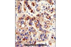 Formalin-fixed and paraffin-embedded human hepatocarcinoma with PON3 Antibody (N-term), which was peroxidase-conjugated to the secondary antibody, followed by DAB staining.