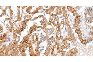 Immunohistochemistry of paraffin-embedded Human thyroid cancer using ACY3 Polyclonal Antibody at dilution of 1:35