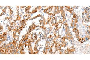 Immunohistochemistry of paraffin-embedded Human thyroid cancer using ACY3 Polyclonal Antibody at dilution of 1:35 (Aminoacylase 3 anticorps)