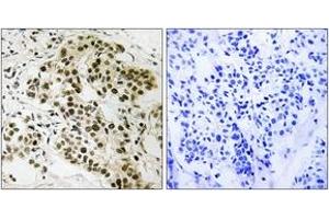 Immunohistochemistry analysis of paraffin-embedded human breast carcinoma tissue, using Retinoblastoma (Ab-252) Antibody. (Retinoblastoma Protein (Rb) anticorps  (AA 221-270))