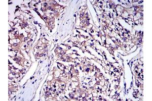 Immunohistochemical analysis of paraffin-embedded human kidney cancer tissues using IRAK4 mouse mAb with DAB staining.