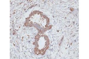 Immunohistochemistry of paraffin-embedded Human breast using TGFBR2 Polyclonal Antibody at dilution of 1:100 (40x lens). (TGFBR2 anticorps)