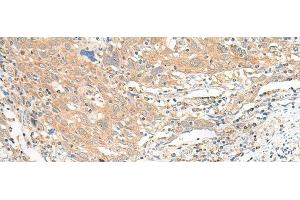 Immunohistochemistry of paraffin-embedded Human cervical cancer tissue using SLC6A9 Polyclonal Antibody at dilution of 1:25(x200) (GLYT1 anticorps)