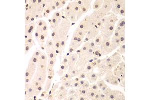 Immunohistochemistry of paraffin-embedded human liver cancer using UHRF2 antibody. (UHRF2 anticorps)