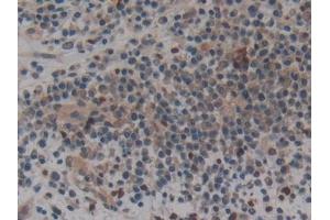 Detection of CPB2 in Human Skin cancer Tissue using Polyclonal Antibody to Carboxypeptidase B2 (CPB2)