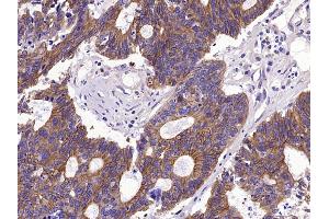 Paraformaldehyde-fixed, paraffin embedded Human stomach cancer Antigen retrieval by boiling in sodium citrate buffer (pH6.