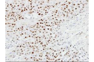 IHC-P Image Immunohistochemical analysis of paraffin-embedded SCC4 xenograft, using p63, antibody at 1:100 dilution.