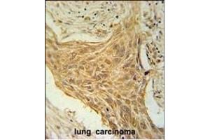 CSAG2 Antibody (N-term) (ABIN651616 and ABIN2840327) immunohistochemistry analysis in formalin fixed and paraffin embedded human lung carcinoma followed by peroxidase conjugation of the secondary antibody and DAB staining. (CSAG2 anticorps  (N-Term))