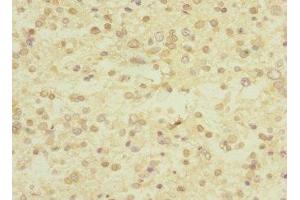 Immunohistochemistry of paraffin-embedded human glioma using ABIN7174375 at dilution of 1:100 (UBE4A anticorps  (AA 797-1066))