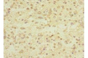 Immunohistochemistry of paraffin-embedded human glioma using ABIN7174375 at dilution of 1:100 (UBE4A anticorps  (AA 797-1066))