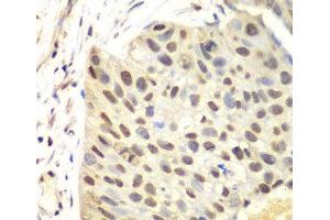 Immunohistochemistry of paraffin-embedded Human lung cancer using FEN1 Polyclonal Antibody at dilution of 1:100 (40x lens).