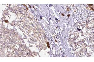 ABIN6279821 at 1/100 staining Human Melanoma tissue by IHC-P. (CCL1 anticorps  (Internal Region))