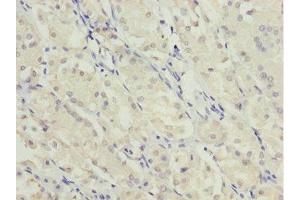 Immunohistochemistry of paraffin-embedded human gastric cancer using ABIN7174959 at dilution of 1:100 (MYO5C anticorps  (AA 270-420))