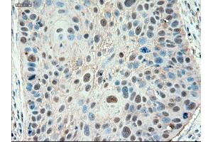Immunohistochemical staining of paraffin-embedded Adenocarcinoma of colon using anti-PTCH1 (ABIN2452537) mouse monoclonal antibody. (Patched 1 anticorps  (AA 122-436))
