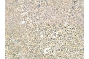 ABIN6260396 and ABIN6272490 at 1/100 staining human hepatocellular carcinoma by IHC-P.