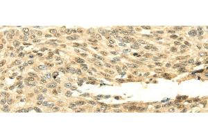 Immunohistochemistry of paraffin-embedded Human lung cancer tissue using SHPRH Polyclonal Antibody at dilution 1:45 (SHPRH anticorps)