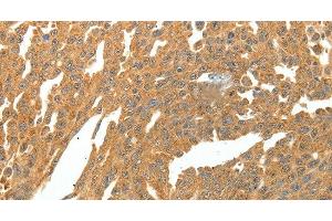 Immunohistochemistry of paraffin-embedded Human ovarian cancer using SKP1 Polyclonal Antibody at dilution of 1:30 (SKP1 anticorps)