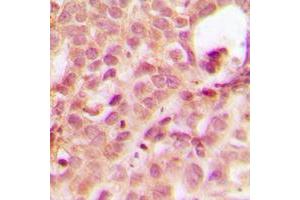 Immunohistochemical analysis of ABL1 staining in human breast cancer formalin fixed paraffin embedded tissue section. (ABL1 anticorps  (N-Term))