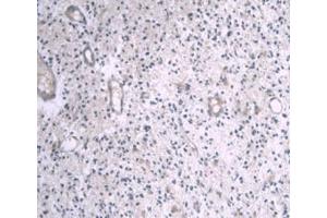 IHC-P analysis of Human Glioma Tissue, with DAB staining. (APOA1 anticorps  (AA 122-267))