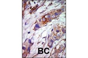 Formalin-fixed and paraffin-embedded human cancer tissue reacted with the primary antibody, which was peroxidase-conjugated to the secondary antibody, followed by AEC staining.
