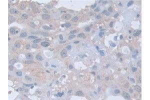 Detection of RARa in Human Breast cancer Tissue using Polyclonal Antibody to Retinoic Acid Receptor Alpha (RARa) (Retinoic Acid Receptor alpha anticorps  (AA 68-173))