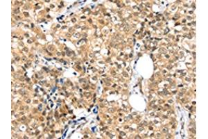 The image on the left is immunohistochemistry of paraffin-embedded Human breast cancer tissue using ABIN7192874(TPR Antibody) at dilution 1/20, on the right is treated with synthetic peptide. (TPR anticorps)