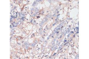 Immunohistochemistry of paraffin-embedded Human colon carcinoma using ZNRF3 Polyclonal Antibody at dilution of 1:100 (40x lens). (ZNRF3 anticorps)