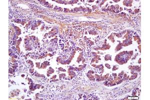 Formalin-fixed and paraffin embedded human lung carcinoma labeled with Anti-Wnt8b Polyclonal Antibody, Unconjugated (ABIN716306) at 1:200 followed by conjugation to the secondary antibody and DAB staining