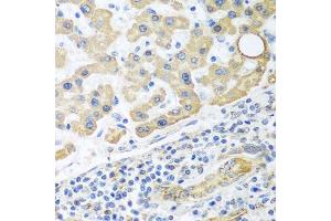 Immunohistochemistry of paraffin-embedded human liver cancer using GLUD1 antibody.