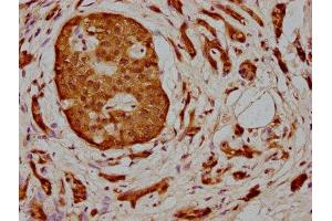 IHC image of ABIN7160033 diluted at 1:400 and staining in paraffin-embedded human pancreatic cancer performed on a Leica BondTM system.