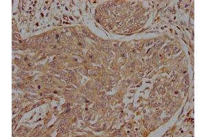 IHC image of ABIN7156340 diluted at 1:200 and staining in paraffin-embedded human cervical cancer performed on a Leica BondTM system.