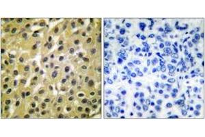 Immunohistochemistry analysis of paraffin-embedded human breast carcinoma tissue, using MDM2 Antibody. (MDM2 anticorps  (AA 391-440))