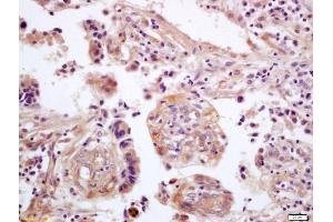 Formalin-fixed and paraffin embedded human lung carcinoma labeled with Anti-WNT5A Polyclonal Antibody, Unconjugated (ABIN675758) at 1:200 followed by conjugation to the secondary antibody and DAB staining