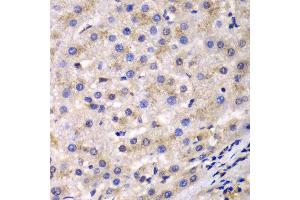 Immunohistochemistry of paraffin-embedded human liver cancer using EEF2 antibody at dilution of 1:100 (400x lens). (EEF2 anticorps)