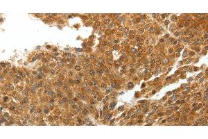 Immunohistochemistry of paraffin-embedded Human liver cancer tissue using TNXB Polyclonal Antibody at dilution 1:40 (TNXB anticorps)