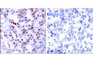 Peptide - +Immunohistochemical analysis of paraffin-embedded human breast carcinoma tissue using c-Jun (Ab-243) antibody (#B7130). (C-JUN anticorps  (Ser243))