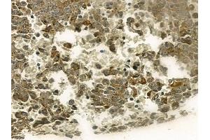 ABIN6256633 and ABIN6267212 at 1/100 staining human melanoma by IHC-P. (CDK6 anticorps  (pTyr13))