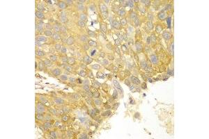 Immunohistochemistry of paraffin-embedded human lung cancer using ACTN1 antibody. (ACTN1 anticorps  (AA 1-330))