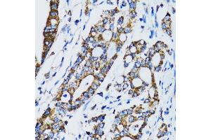 Immunohistochemistry of paraffin-embedded human colon carcinoma using STAT3 antibody (ABIN6293492) at dilution of 1:100 (40x lens). (STAT3 anticorps)