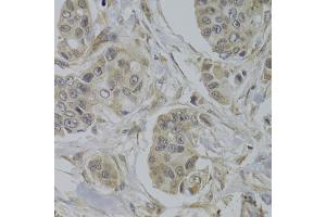 Immunohistochemistry of paraffin-embedded human breast cancer using AKT1S1 Antibody (ABIN5973672) at dilution of 1/100 (40x lens). (PRAS40 anticorps)