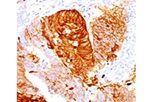 IHC testing of FFPE human colon carcinoma with ALDH1 antibody (clone AHDH1-1). (ALDH1A1 anticorps  (AA 315-434))