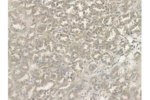 ABIN6265762 and ABIN6268946 at 1/100 staining human renal cell carcinoma by IHC-P.