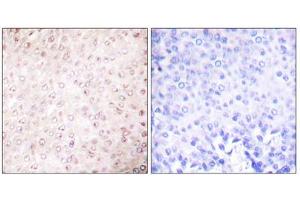 Immunohistochemical analysis of paraffin-embedded human breast carcinoma tissue using P300/CBP Antibody (ABIN5976479). (CBP anticorps  (C-Term))