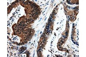 Immunohistochemical staining of paraffin-embedded liver tissue using anti-L1CAM mouse monoclonal antibody. (L1CAM anticorps)
