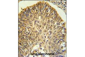 LRG1 Antibody IHC analysis in formalin fixed and paraffin embedded lung carcinoma followed by peroxidase conjugation of the secondary antibody and DAB staining.
