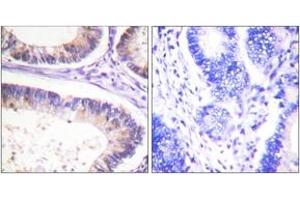 Immunohistochemistry analysis of paraffin-embedded human colon carcinoma, using CBL (Phospho-Tyr674) Antibody. (CBL anticorps  (pTyr674))