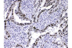 HnRNP A1 was detected in paraffin-embedded sections of human intestinal cancer tissues using rabbit anti- HnRNP A1 Antigen Affinity purified polyclonal antibody (Catalog # ) at 1 µg/mL.