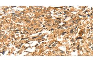 Immunohistochemistry of paraffin-embedded Human esophagus cancer tissue using DIRAS1 Polyclonal Antibody at dilution 1:52