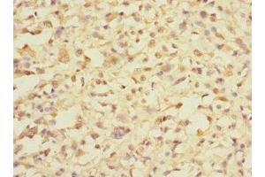 Immunohistochemistry of paraffin-embedded human melanoma using ABIN7164368 at dilution of 1:100 (DDX59 anticorps  (AA 1-200))